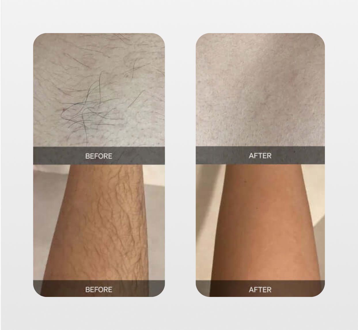 SmoothSkin Painless Hair Remover